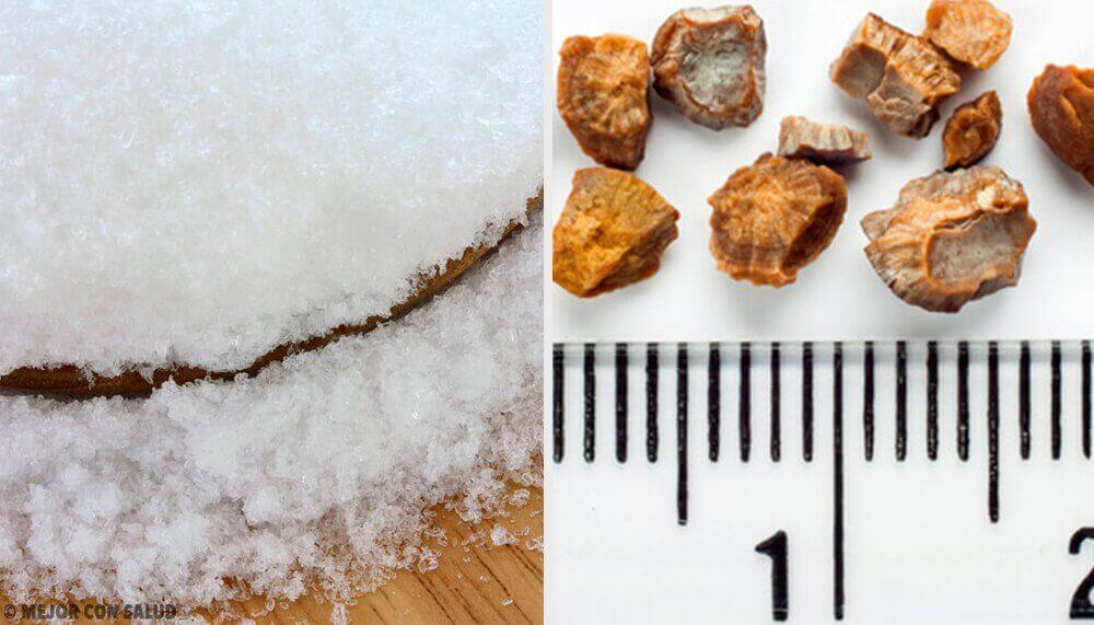 Munuaiskivet voivat johtua eri syistä.