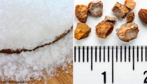 7 kotikonstia munuaiskiviin