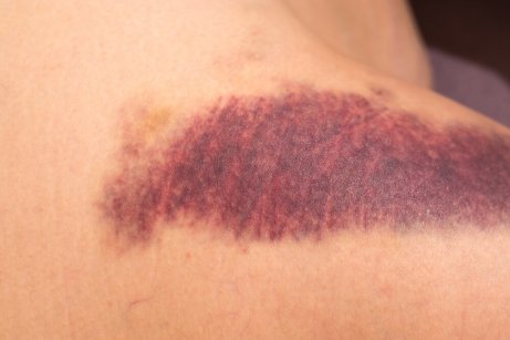 K-vitamiinin puutteesta kärsivä ihminen voi saada mustelmia herkästi.