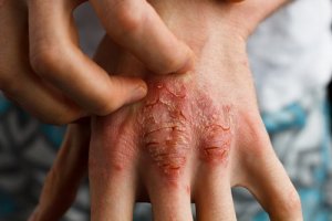 Psoriasiksen hoito sarsaparillan avulla