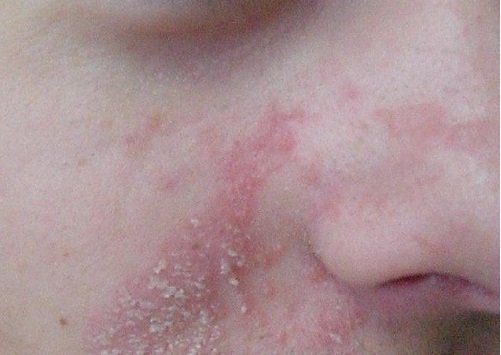 Tali-ihottumaan on olemassa myös luonnollisia hoitokeinoja.