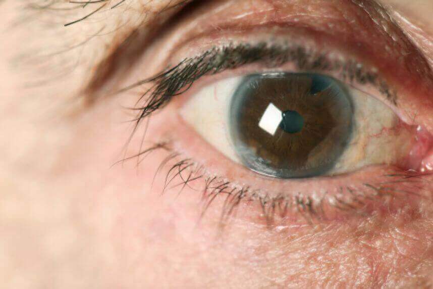 silmässä glaukoomaa