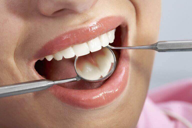 ehkäise hampaiden reikiintyminen