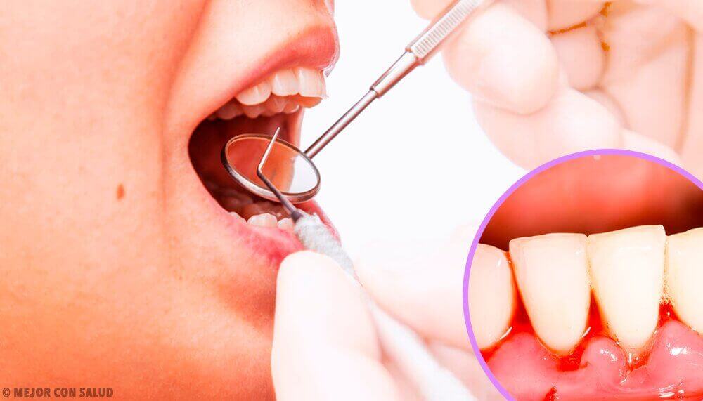 Ientulehduksen syynä on useimmiten kerääntynyt plakki ja hammaskivi.