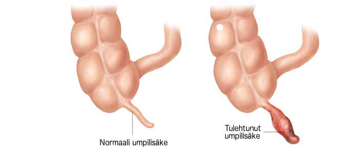 tulehtunut umpilisäke