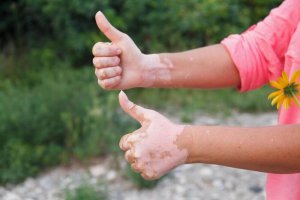 Autoimmuunisairaudet: mitä ruokia tulisi syödä ja välttää