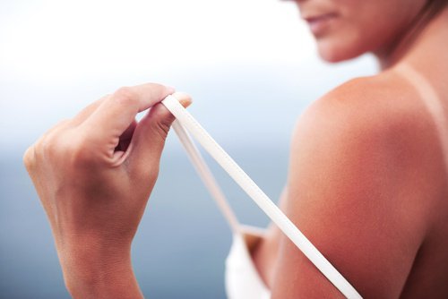 Hoida auringon polttamaa ihoa näiden 5 luontaishoidon avulla