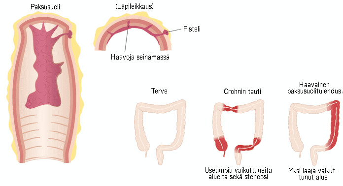 Crohnin tauti vs. haavainen paksusuolentulehdus