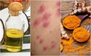 5 kotihoitoa follikuliittiin eli karvatuppitulehdukseen