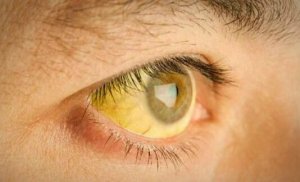 keltatauti enteilee vitamiinipuutosta