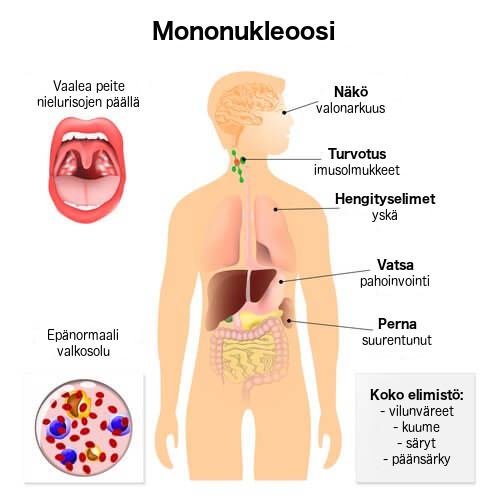 mononukleoosin oireet