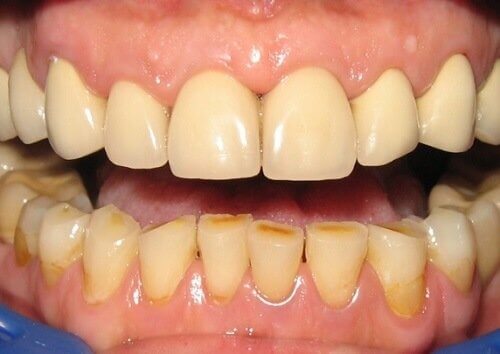 hammastulehduksen oireet: punaisuus