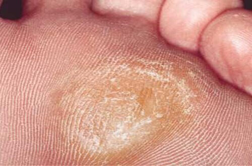 5 luontaishoitoa kovettumien pehmentämiseksi