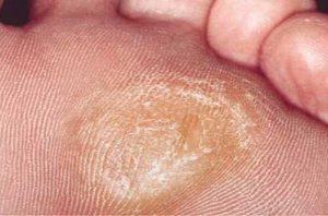 5 luontaishoitoa kovettumien pehmentämiseksi