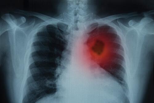 keuhkosyöpä näkyy röntgenkuvissa