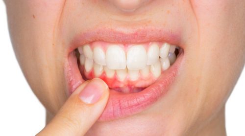 hammastulehduksen oireet: hammasmätä