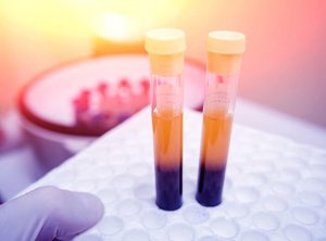 4 keinoa verihiutaleiden määrän kohentamiseen