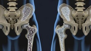 6 ruokavaliovinkkiä, jotka auttavat ehkäisemään osteoporoosia