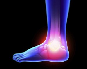 Kuinka hoidat nyrjähdyksen oireita luonnollisella tavalla