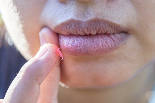 naisen halkeilevat huulet