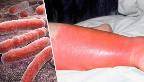 Ruusu: syyt, oireet ja hoito