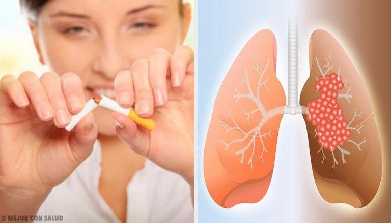 Keuhkosyövän aiheuttajat ja diagnoosi