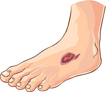 Diabeetikko ei välttämättä huomaa jalan haavaa