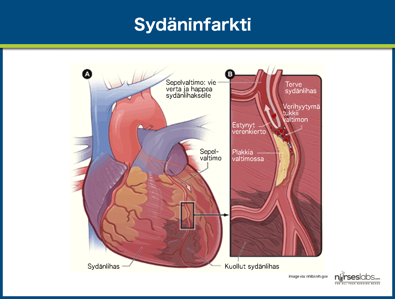 Is Myocardial Infarction A Chronic Condition Is Myocardial Infarction A Chronic Condition