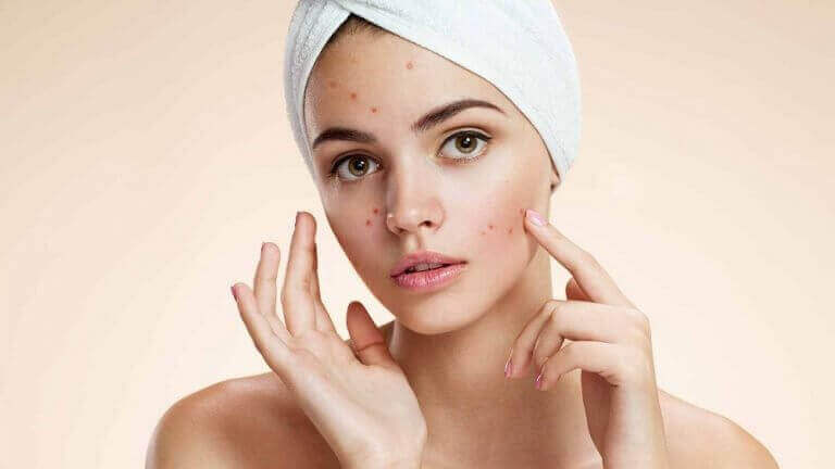 iho-ongelmien hoito: akne
