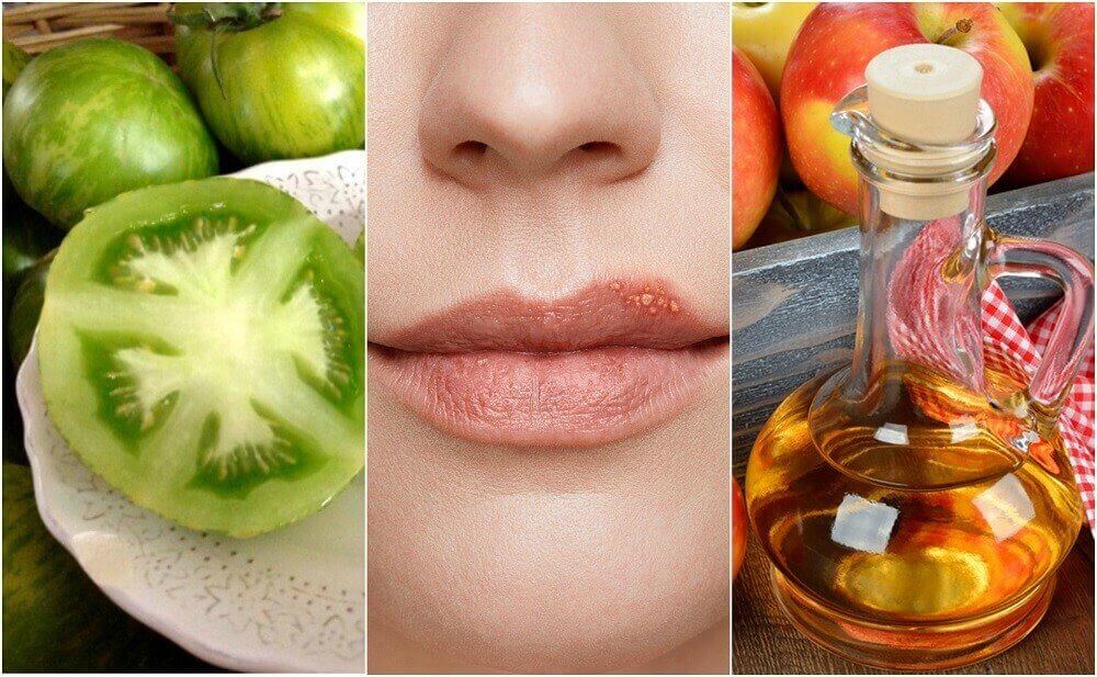 5 luontaishoitoa huuliherpekseen