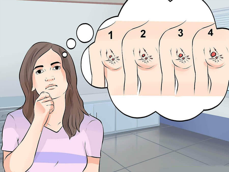 Kipu kainalossa voi johtua rintasyövästä