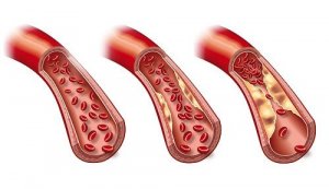 Viikon ruokavalio triglyseridien alentamiseen