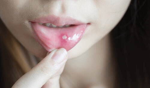 Suun haavaumien ja aftojen hoito