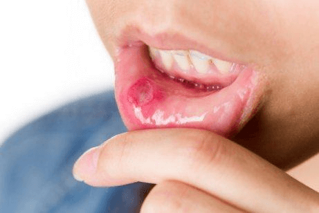 Suun haavauma voi olla kivulias