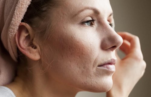 8 tehokasta keinoa laajentuneiden ihohuokosten supistamiseen