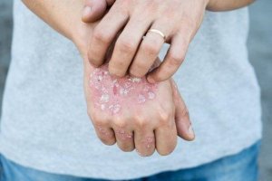 Paikalliset yrttihoidot psoriasikseen: 5 vaihtoehtoa