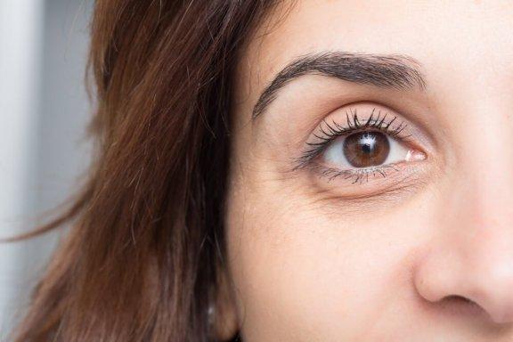 Tummien silmänalusten hoito: 10 takuuvarmaa keinoa