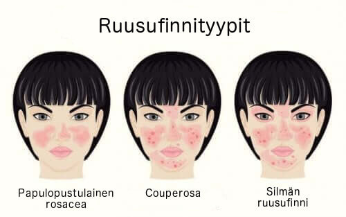 eri ruusufinnityypit