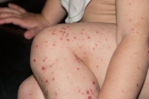 Mikä on coxsackievirus ja miten siltä voidaan suojautua?