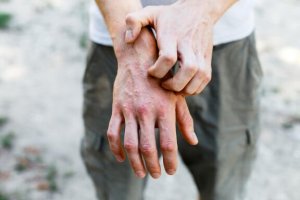 Kosketusihottuman hoito 6 kotikonstilla