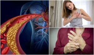 Kärsitkö tietämättäsi korkeasta kolesterolista? Näiden oireiden avulla selvität sen!