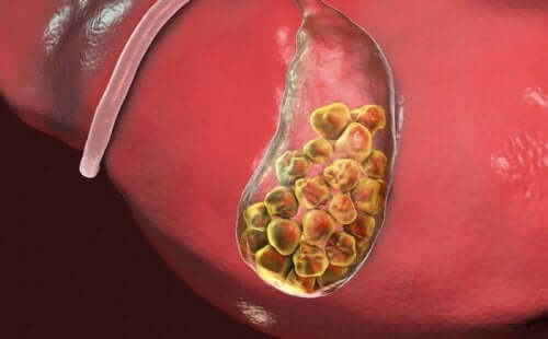 tämä ihminen kärsii sappikivistä