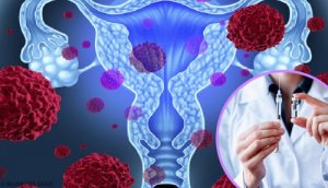 cancer in ovarian cysts infestare cu viermi