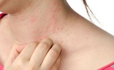 Nokkosihottuman hoito luonnollisesti