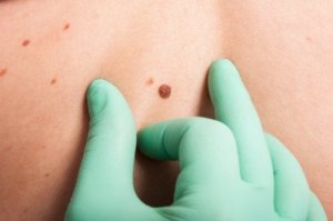 ABCDE-sääntö ihosyövän diagnosointiin