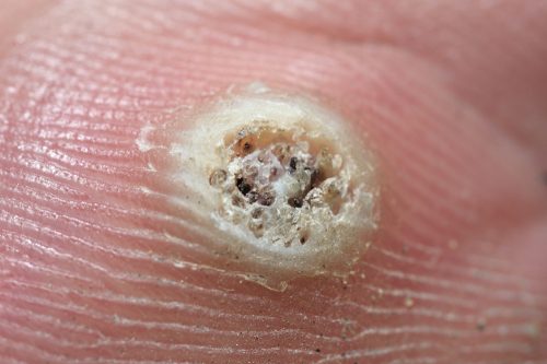 Hpv miehella oireet - Eyelid skin papilloma Hpv virus oireet