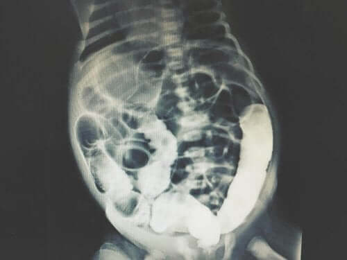 Vatsaontelo röntgenissä