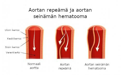 aortan repeämä ja hematooma