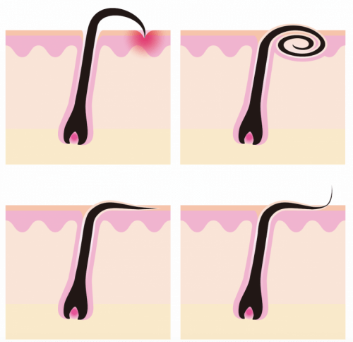 sisäänkasvaneiden karvojen kaavio