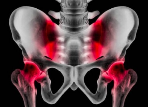 Urheilijan nivuskipu: syyt, oireet ja hoito